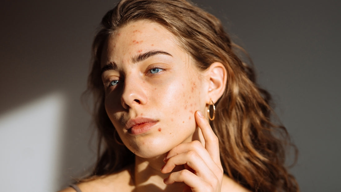 Say Goodbye to Acne Marks: The Ultimate Skincare Routine